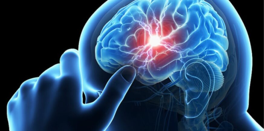 Εγκεφαλικό: Βιοδείκτες «εγκεφαλικής ηλικίας» προβλέπουν με ακρίβεια την έκβασή του