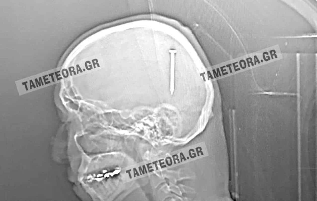 Καρφί 5 εκατοστών σφηνώθηκε στο κεφάλι άνδρα στην Καλαμπάκα ΦΩΤΟ