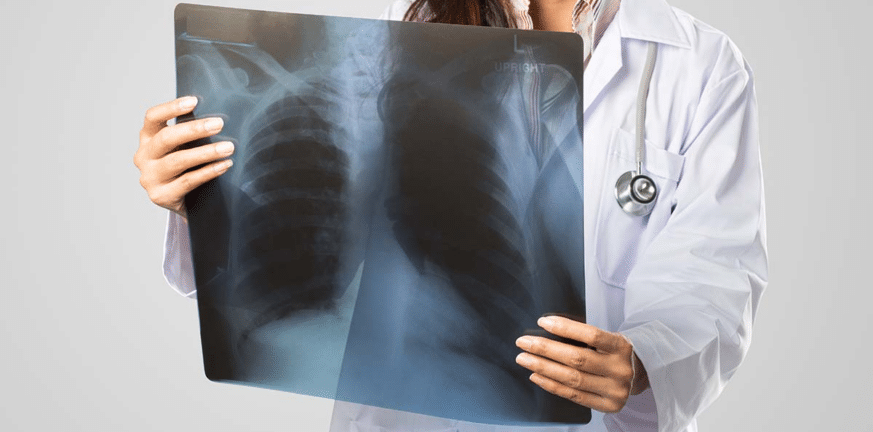 Καρκίνος Πνεύμονα: Ο απρόσμενος παράγοντας που αυξάνει τον κίνδυνο