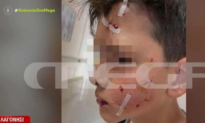 Λαγονήσι - Επίθεση σκύλου σε 14χρονο: Συγκλονίζει η μητέρα του - «Αν δεν ήταν ένας μπαμπάς κοντά, θα τον είχε σκοτώσει» ΒΙΝΤΕΟ
