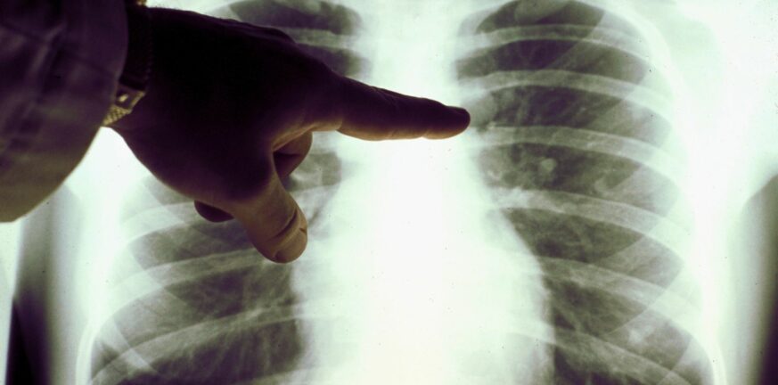Νίκος Τζανάκης: Μία μικρή πόλη χάνεται κάθε χρόνο στην Ευρώπη από καρκίνο του πνεύμονα – Αύξηση 17%