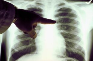 Καρκίνος του πνεύμονα: Ο Προσυμπτωματικός Έλεγχος - Τι συμβουλεύουν οι επιστήμονες 