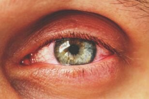 Πώς επηρεάζει η Άνοιξη στα μάτια μας - Τα προβλήματα που προκαλεί