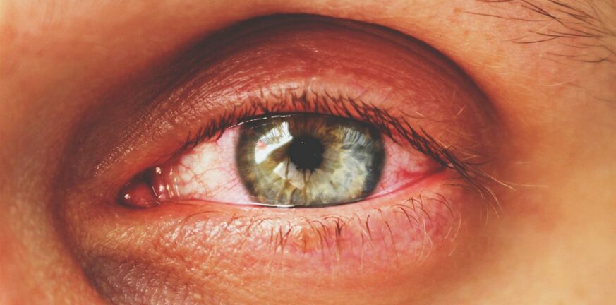Πώς επηρεάζει η Άνοιξη στα μάτια μας - Τα προβλήματα που προκαλεί