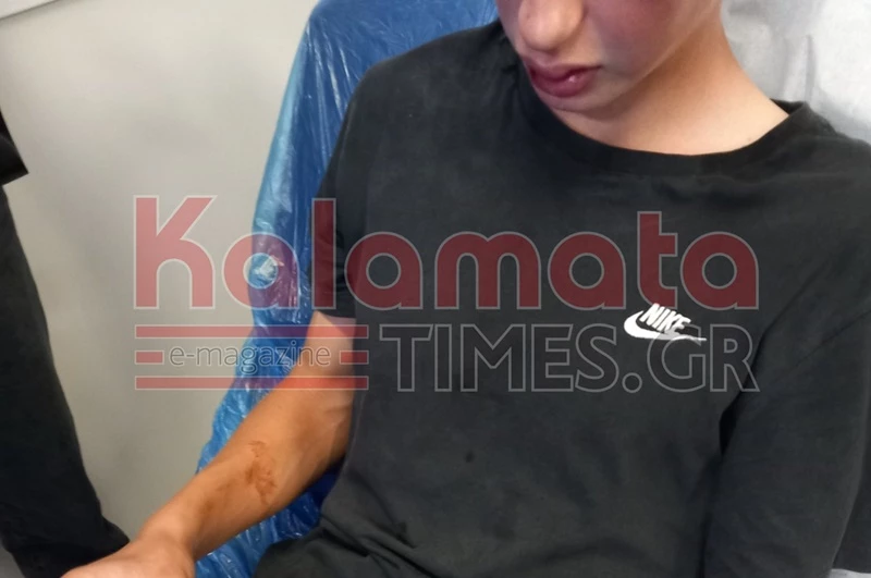 Καλαμάτα: Άγριος ξυλοδαρμός 16χρονων από συμμορία ανηλίκων - «Είπαν ότι δεν έχουν τελειώσει μαζί του» ΒΙΝΤΕΟ - ΦΩΤΟ