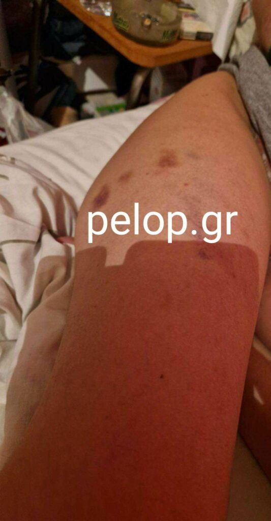 Πάτρα - Μαρτυρία για «μπράβο»: Σοκάρει κοπέλα στην «Π» που κινδύνεψε να πεθάνει από ξυλοδαρμό - ΦΩΤΟ
