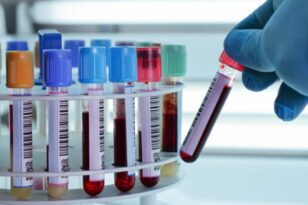 Ζήκος: Ραγδαία εξέλιξη της αιματολογίας – Στόχος η βελτίωση της ποιότητας ζωής των ασθενών