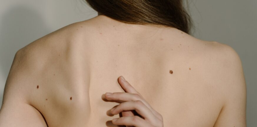 Ελιές στο δέρμα: Δες ποιες μπορεί να είναι επικίνδυνες