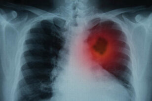 Καρκίνος του πνεύμονα: Μείωση κινδύνου και αύξηση ίασης
