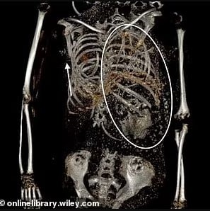 Μια απίστευτη ανακάλυψη έκαναν οι αρχαιολόγοι - Ανατριχιαστικά ευρήματα σε μούμια που πέθανε στην γέννα πριν από 1.500 χρόνια ΦΩΤΟ