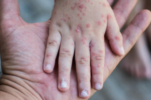 Κοξάκι: Η λοίμωξη που απειλεί τα παιδιά - Ποια τα συμπτώματα