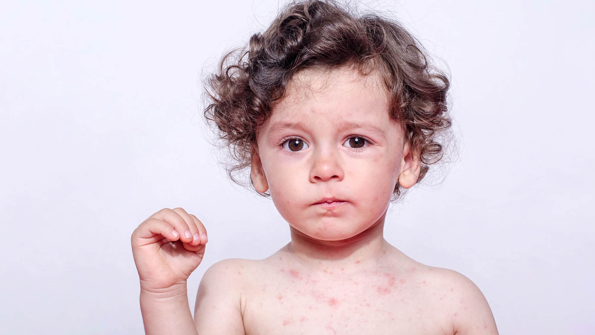 The World Health Organization sounds the alarm about measles – 79% increased cases
 – 2024-02-21 03:12:33