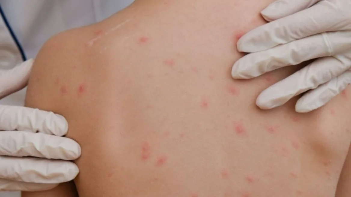 Eight cases of measles in Greece – What do EODY and the Vaccination Committee recommend |  Health.  Articles, news and tips for a healthier life
 – 2024-02-29 07:10:28