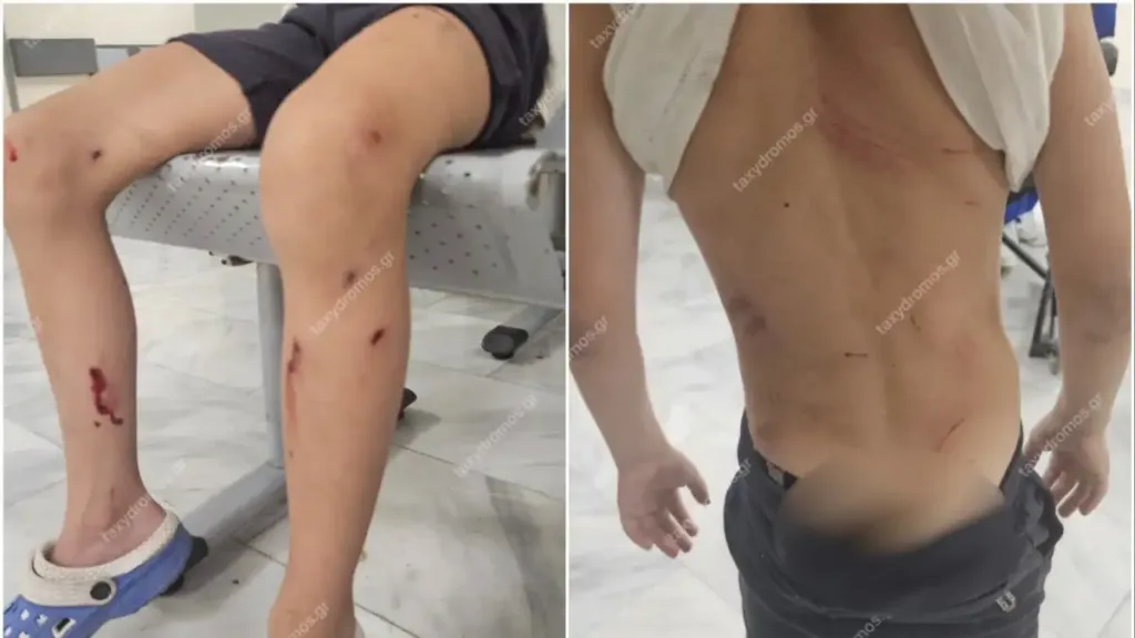 Φρίκη στον Βόλο: Τρία σκυλιά επιτέθηκαν σε 7χρονο ενώ έπαιζε – Στο νοσοκομείο το παιδί με σοβαρά τραύματα ΦΩΤΟ