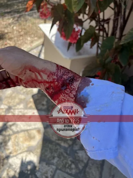 Σκύλος δάγκωσε δικηγόρο! Σοβαρός ο τραυματισμός του στο χέρι ΦΩΤΟ