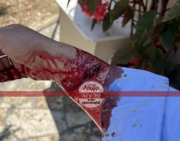 Σκύλος δάγκωσε δικηγόρο! Σοβαρός ο τραυματισμός του στο χέρι ΦΩΤΟ