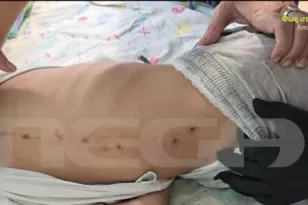 Πάτρα: Τι έδειξε η δεύτερη ιατροδικαστική εξέταση για τα σημάδια στην πλάτη του 10χρονου