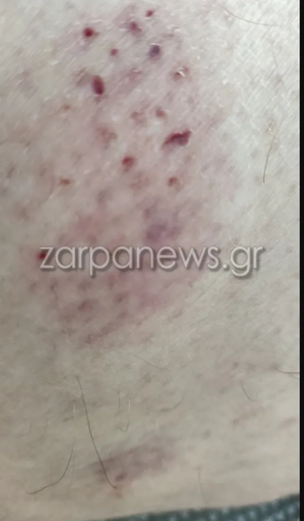 Κρήτη: Θαλάσσια χελώνα δάγκωσε κολυμβητή στα Χανιά