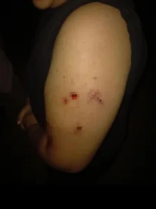 Σκύλος ξέσκισε το χέρι 12χρονου αγοριού, έξαλλη η μάνα του...