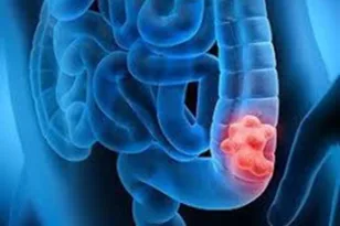 Μελέτη: Γιατί ο καρκίνος του παχέος εντέρου αυξάνεται απότομα στους νέους