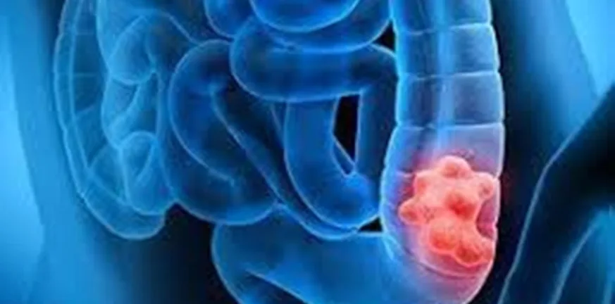 Μελέτη: Γιατί ο καρκίνος του παχέος εντέρου αυξάνεται απότομα στους νέους