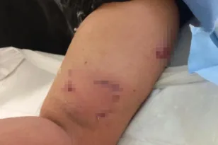 Σκύλος ξέσκισε το χέρι 12χρονου αγοριού, έξαλλη η μάνα του...