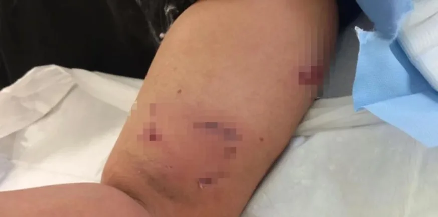 Σκύλος ξέσκισε το χέρι 12χρονου αγοριού, έξαλλη η μάνα του...