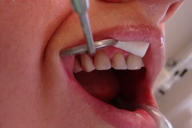 Σφραγίσματα: Η απαγορευμένη επικίνδυνη ουσία, τι ισχύει στην Ευρώπη και άλλες χώρες