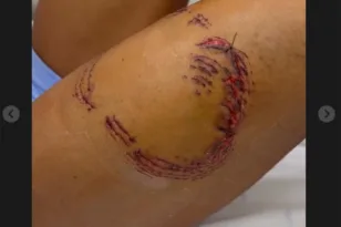 ΒΙΝΤΕΟ από επίθεση καρχαρία σε γυναίκα στη Βραζιλία