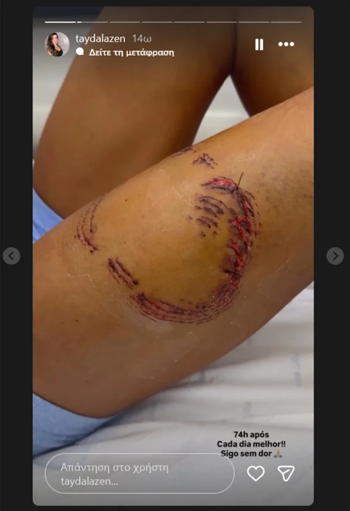 ΒΙΝΤΕΟ από επίθεση καρχαρία σε γυναίκα στη Βραζιλία ΒΙΝΤΕΟ από επίθεση καρχαρία σε γυναίκα στη Βραζιλία