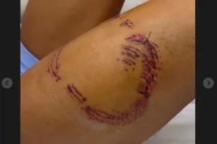 ΒΙΝΤΕΟ από επίθεση καρχαρία σε γυναίκα στη Βραζιλία