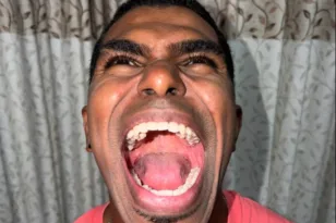 Ρεκόρ γκίνες για 33χρονο Mαλαισιανό που έχει δέκα δόντια περισσότερα!