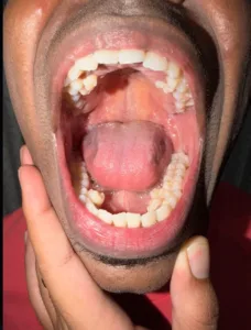 Ρεκόρ γκίνες για 33χρονο Mαλαισιανό που έχει δέκα δόντια περισσότερα!