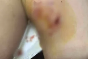 Κρήτη: Άγρια επίθεση σκύλου σε 12χρονο, στο νοσοκομείο με σοβαρά τραύματα ΦΩΤΟ-ΒΙΝΤΕΟ