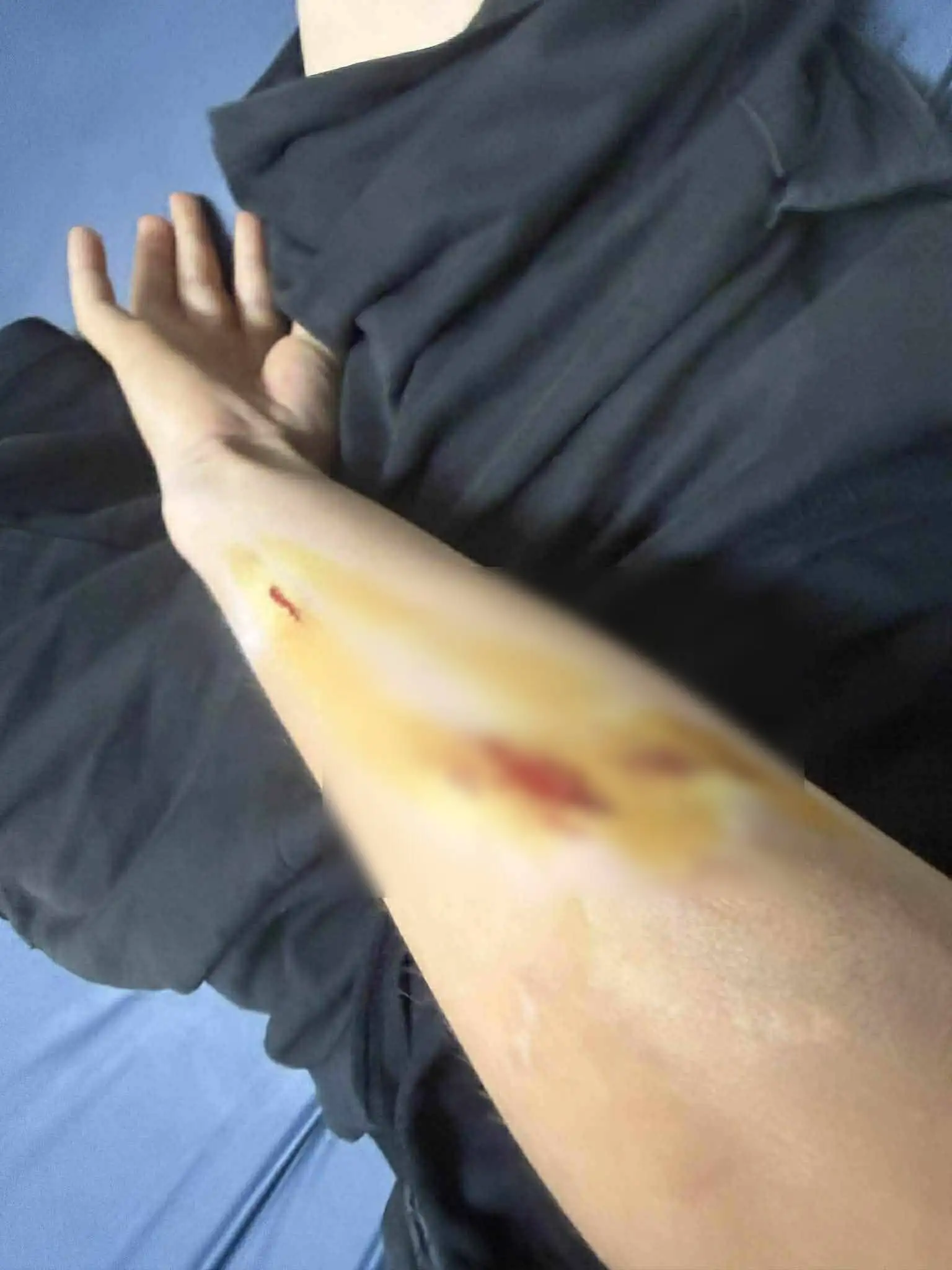 Κρήτη: Άγρια επίθεση σκύλου σε 12χρονο, στο νοσοκομείο με σοβαρά τραύματα ΦΩΤΟ-ΒΙΝΤΕΟ