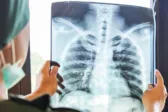Δυτική Ελλάδα: Σοκ με τη φυματίωση, θετικά τα 10 στα 13 μαντού