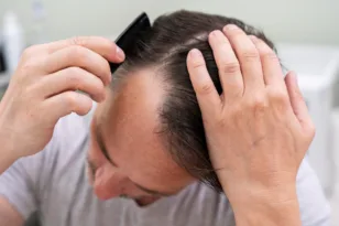 Receding hairline: Can it be reversed or restored?